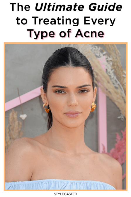 STYLECASTER | acne remedies | acne treatment | cystic acne remedies | hormonal acne | adult acne | 