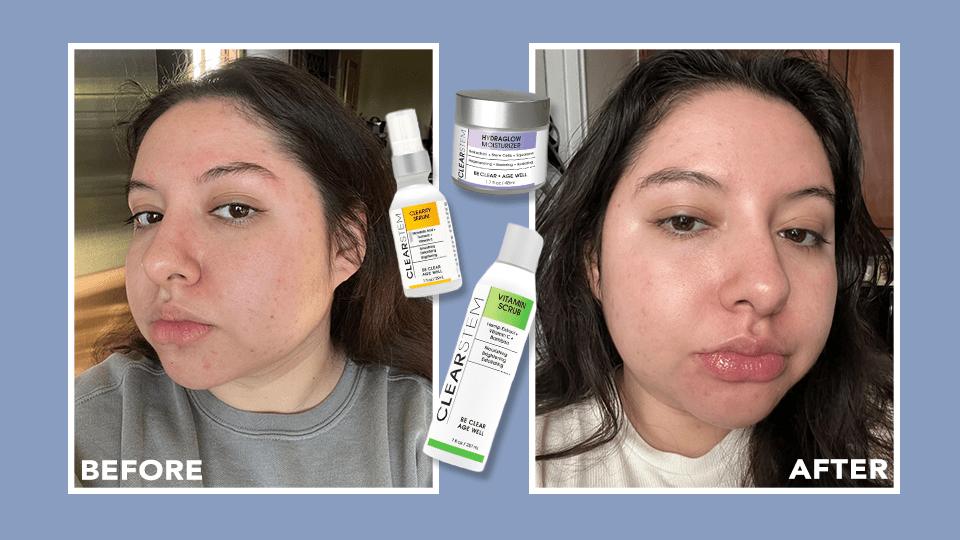 clearstem review acne anti aging